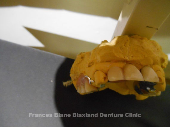 Tooth now added to the denture which is on the model
